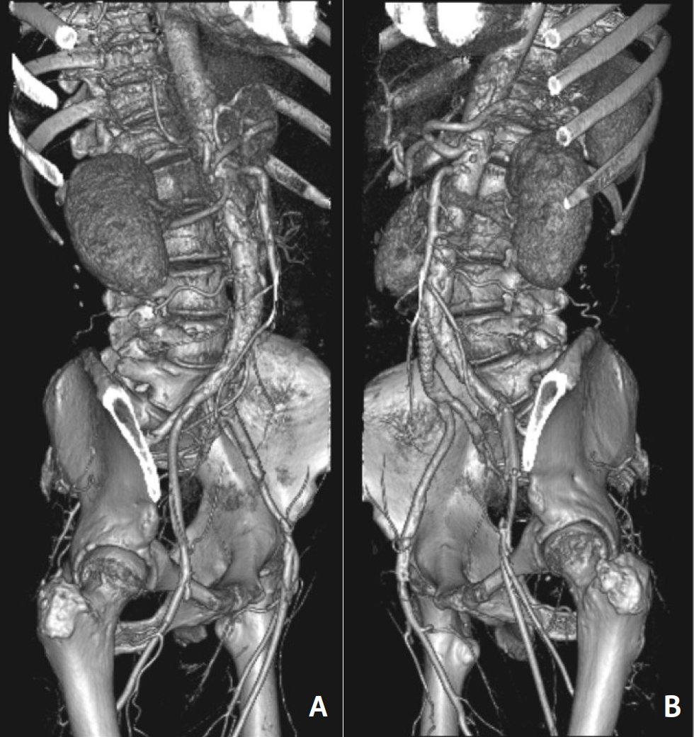 use-of-intravascular-lithotripsy-for-severe-calcification-in
